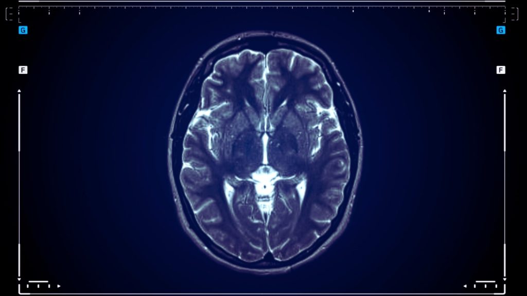 Brain scan illustrating how fentanyl affects the central nervous system